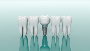 dental implants Charlottesville
