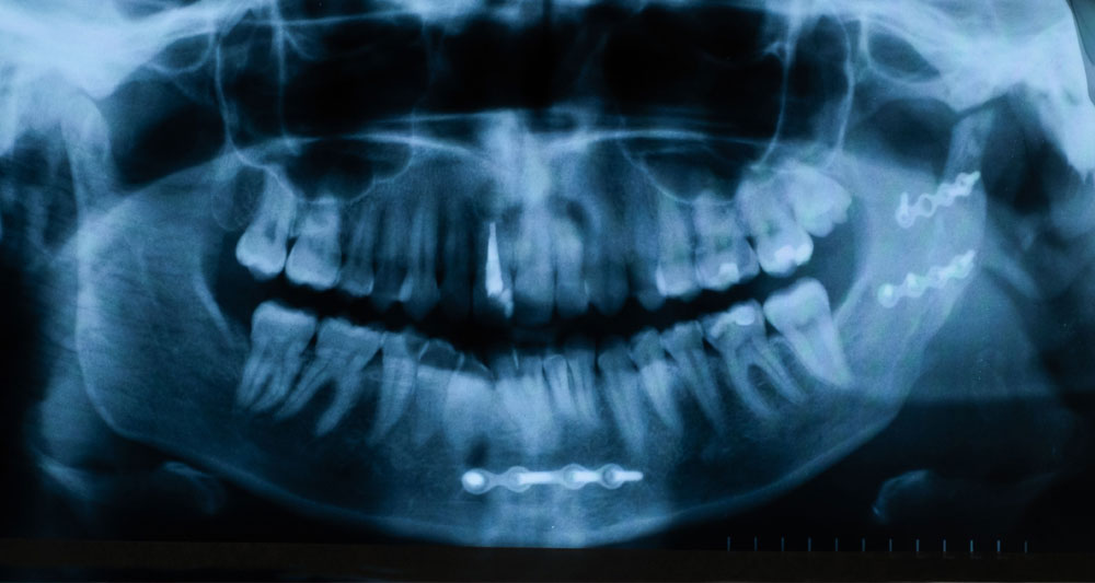 Facial trauma X-ray