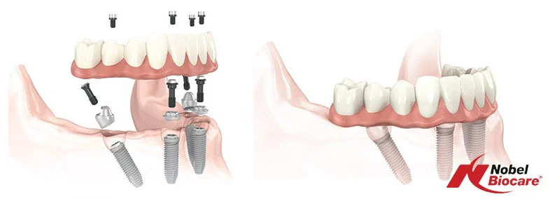 nobel-biocare-dental-implants
