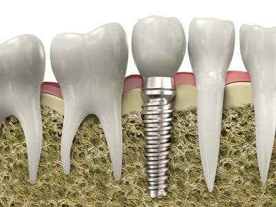 implant dentist Charlottesville