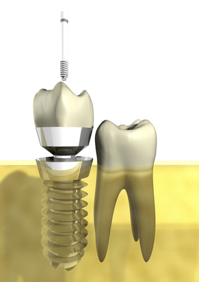 Charlottesville dental implants