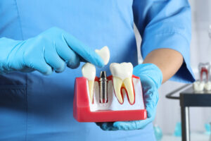 Dentist putting crown onto abutment of dental implant between teeth in clinic, closeup